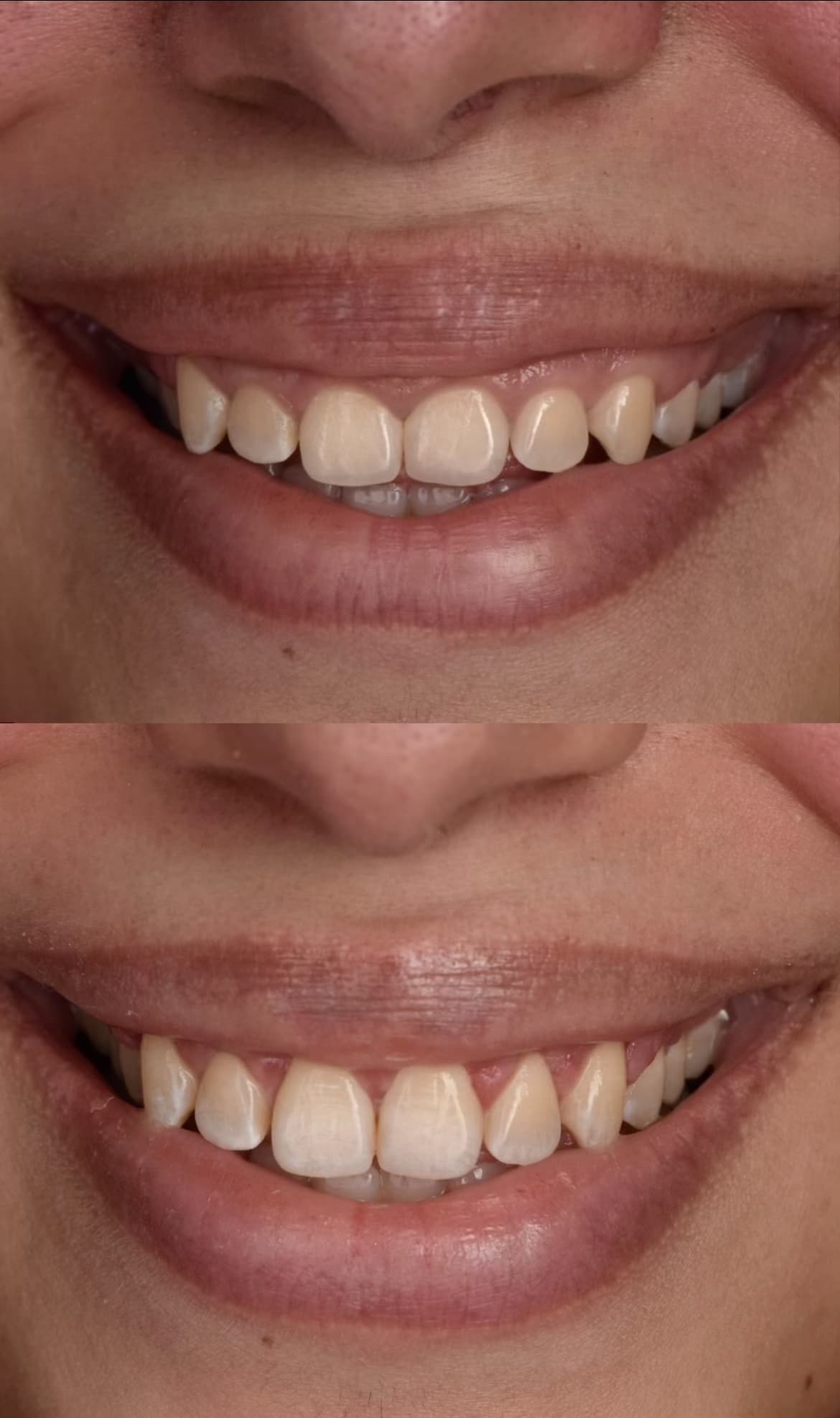 One step to a natural smile